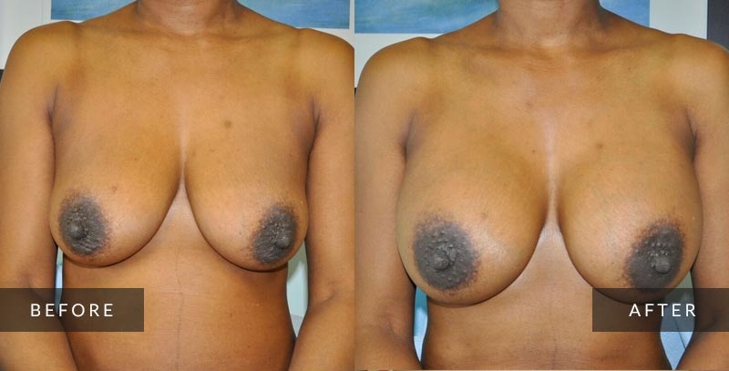 Breast Enlargement Photos - Breast Augmentation Photos - Philadelphia, PA