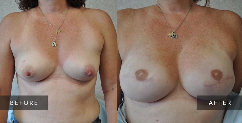 Breast Reconstruction Photo Gallery | Philadelphia, PA