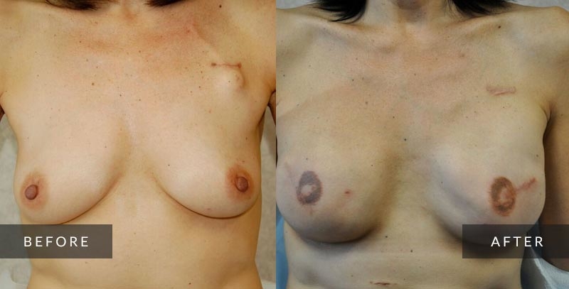 Breast Reconstruction Photo Gallery | Philadelphia, PA