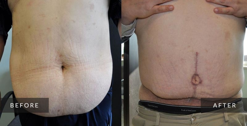 Abdominoplasty photos - Tummy Tuck - Before & After