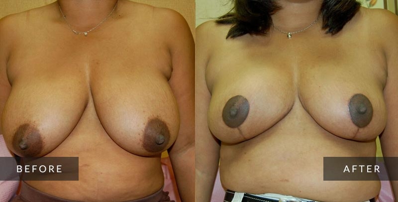 Breast Reduction Photos - Cosmetic Surgeon Philadelphia, PA