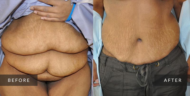 Abdominoplasty photos - Tummy Tuck - Before & After