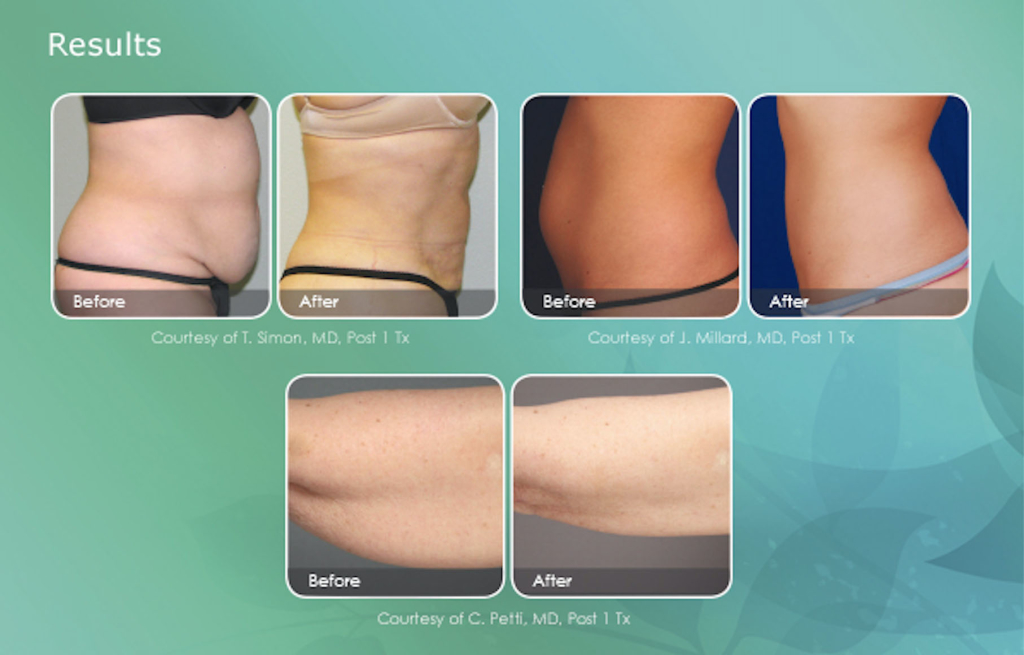 Smart Liposuction, Laser Liposuction