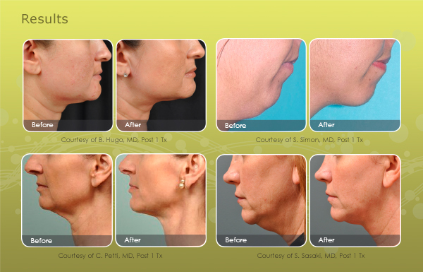 Skin Tightening Treatment, Laser Skin tightening